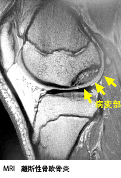 離断性骨軟骨炎