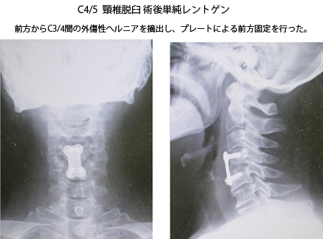 頸椎捻挫