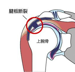 腱板断裂