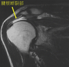 腱板断裂
