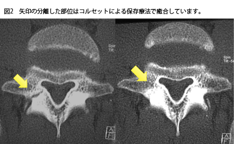 腰椎分離症