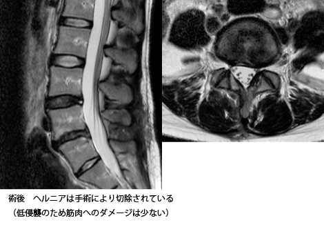 ヘルニア